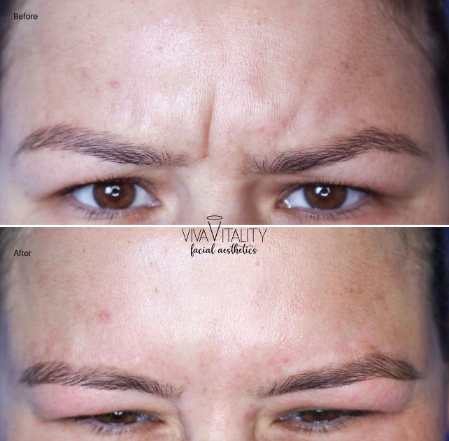 How does Botox work by Viva Vitality in South Florida Ave Lakeland FL