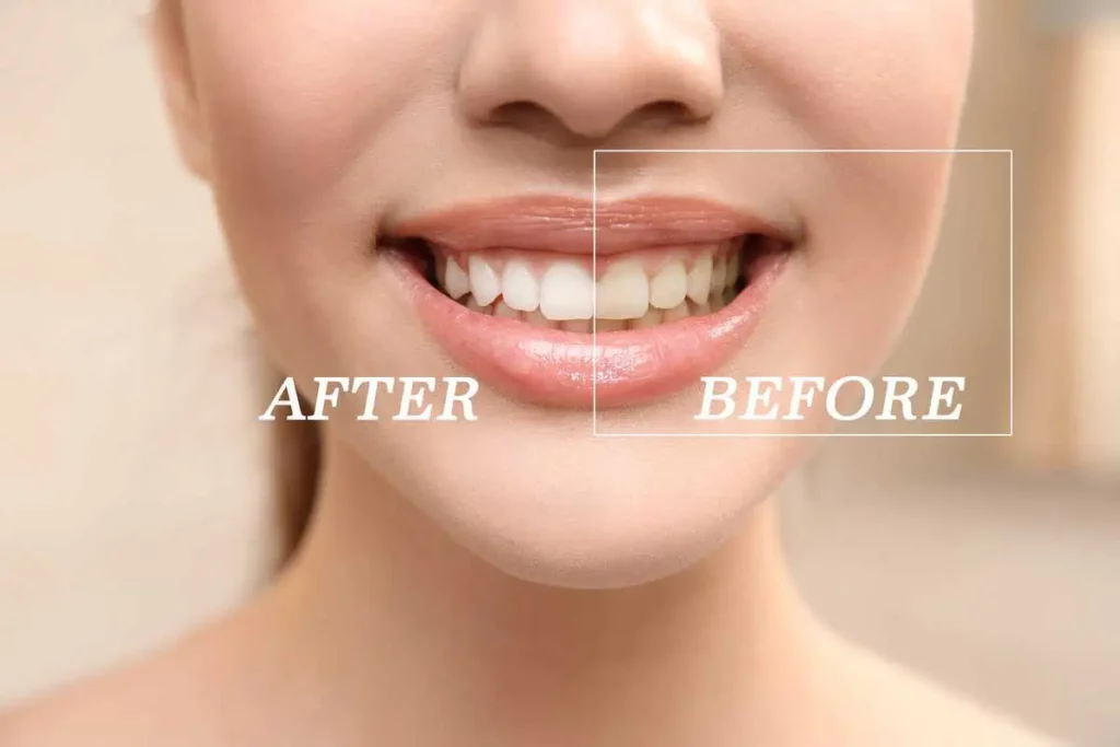 Teeth Whitening by Viva Vitality in FL