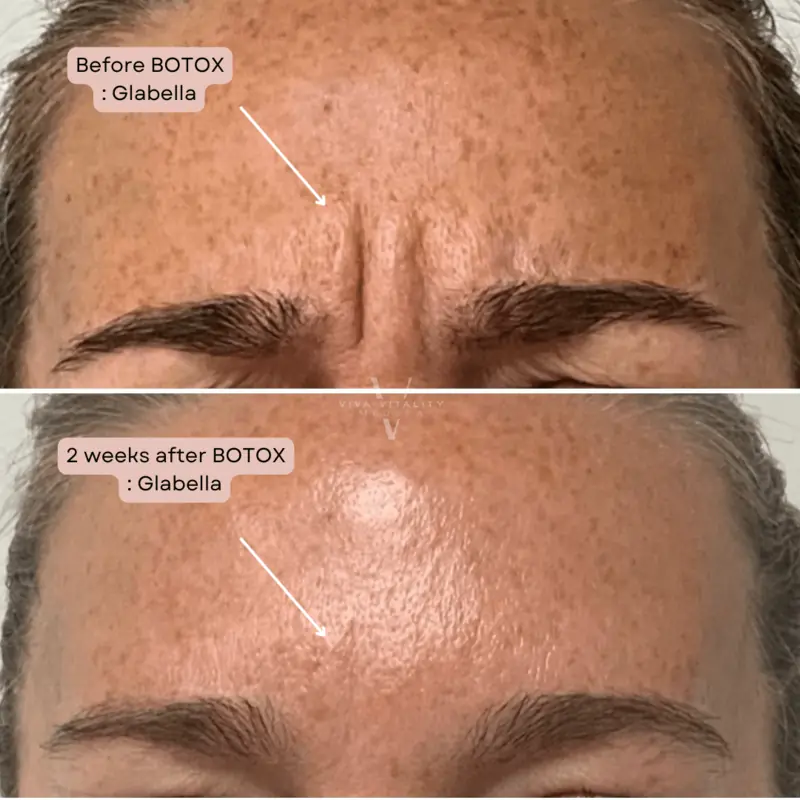 Botox and Dysport by Viva Vitality in Lakeland FL