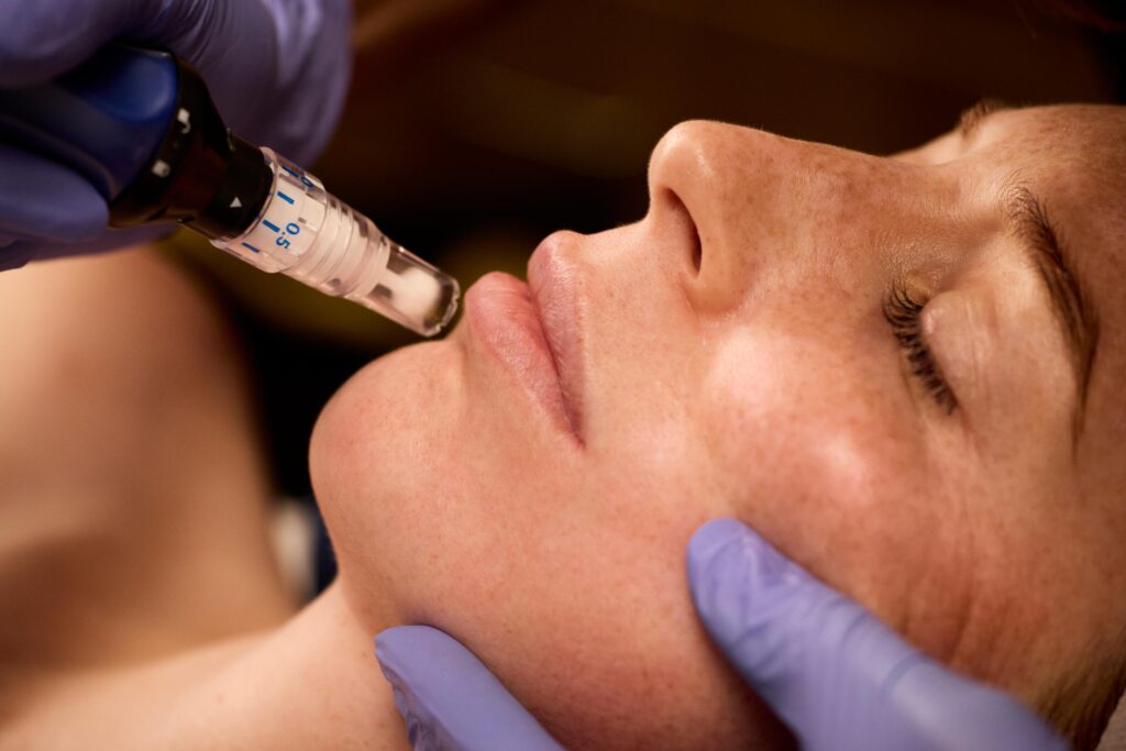 skinpen microneedling before and after