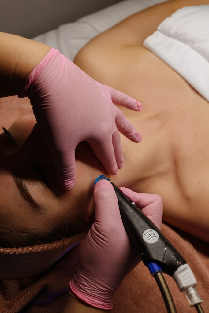 Hydrafacial treatment along the neck at Viva Vitality MedSpa in Lakeland, Florida