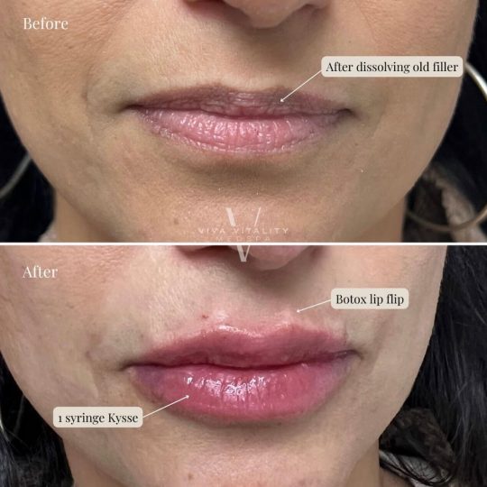 Dermal Filler - B&A -7