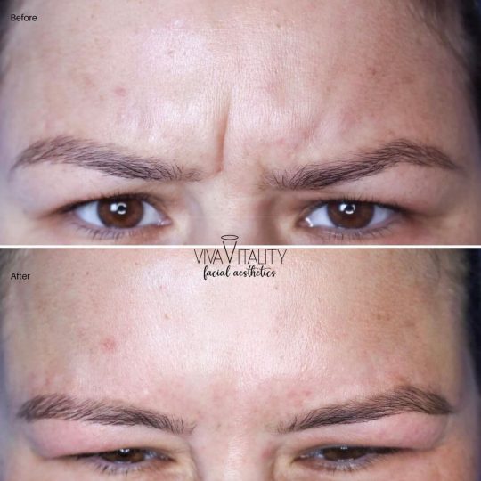 Botox & Dysport - B&A - 1