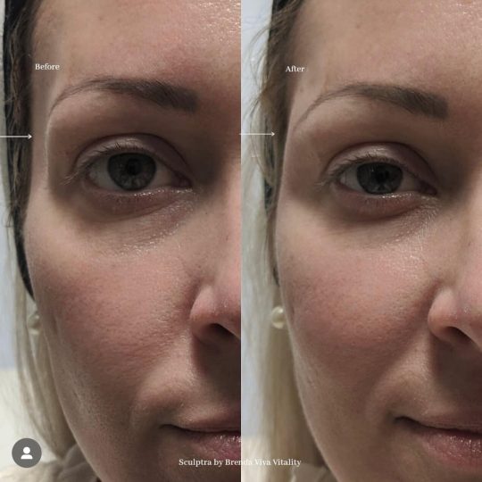 Sculptra - B&A - 2