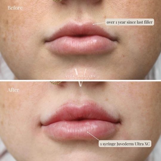 Dermal Filler