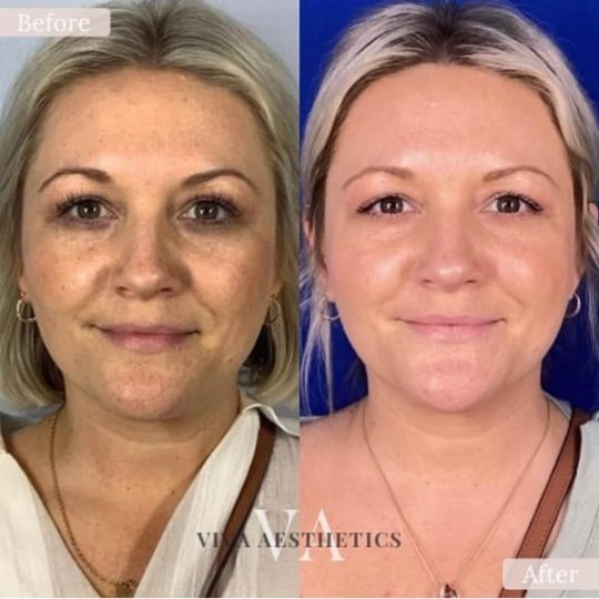 Chemical Peels - B&A - 1