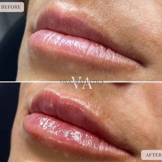 Dermal Filler - B&A -