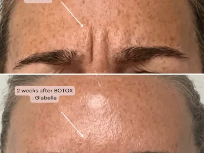 Botox and Dysport by Viva Vitality in Lakeland FL