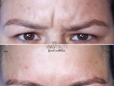 How does Botox work by Viva Vitality in South Florida Ave Lakeland FL