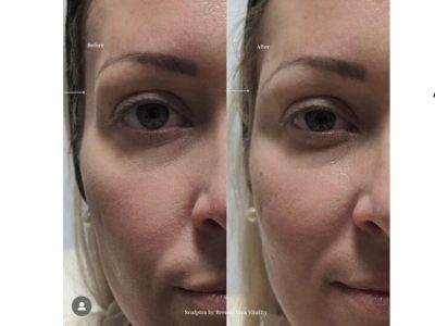 Sculptra Aesthetic before and after image