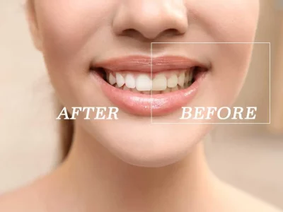 Teeth Whitening by Viva Vitality in FL